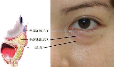 眼袋的形成及治疗 眼袋是怎么形成的 眼袋的治疗方法