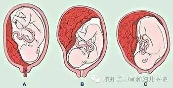 孕早期出血的原因分析 孕期阴道出血5大原因分析