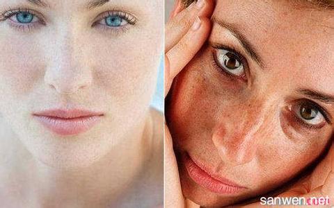 面部黑斑的形成 黑斑是怎样形成的 黑斑的预防方法
