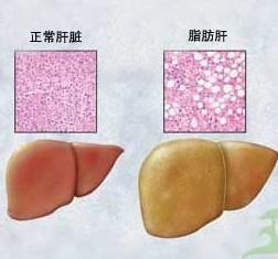 脂肪肝的治疗方法 治疗脂肪肝有什么方法