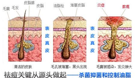 一个痘痘的形成过程 青春痘是怎样形成的