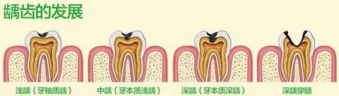 蛀牙黑色的怎么除去 蛀牙是怎么形成的