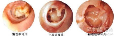 中耳炎是怎么形成的 中耳炎形成的原因_中耳炎的表现
