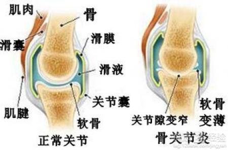 骨关节炎能治好吗 骨关节炎形成的原因
