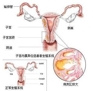 子宫肌瘤怎么形成的 宫血是怎么形成的