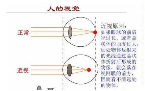 怎么预防散光 散光怎么形成的 怎么预防散光的形成