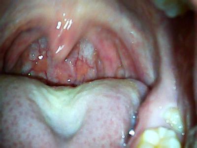 喉咙的痰从哪里来的 喉咙的痰是怎么形成的