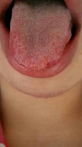 舌头老发干是怎么回事 舌干是怎么回事