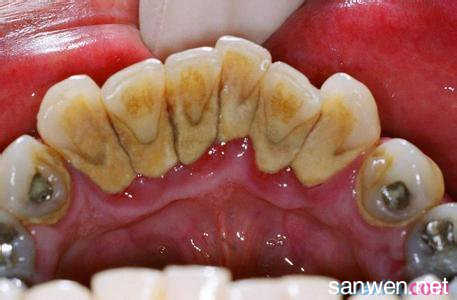 牙齿上的牙垢怎么去除 牙齿的牙垢怎么形成的