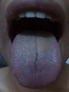 舌苔白厚是什么原因 舌白苔黄是怎么回事
