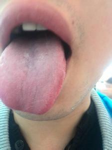舌头老是溃疡怎么办 老是舌头溃疡怎么回事