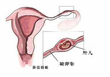 什么原因会造成宫外孕 什么原因造成宫外孕呢