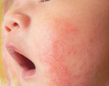 湿疹过敏源有哪些食物 湿疹的过敏源有哪些