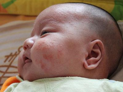 宝宝脸上长湿疹偏方 宝宝脸上长湿疹吃什么偏方