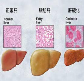肝硬化腹水形成的原因 肝硬化形成的原因 肝硬化有哪些表现