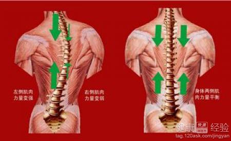 脊椎弯曲怎么矫正 宝宝脊椎弯曲是怎么回事