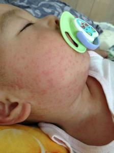 发烧后出疹子注意事项 宝宝发烧后出疹子怎么护理