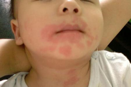 如何防止皮肤过敏 如何防止小孩皮肤过敏