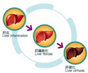 引起肝硬化的主要原因 肝硬化是怎么形成的