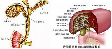 胆小管结石形成的原因 胆管结石形成的原因