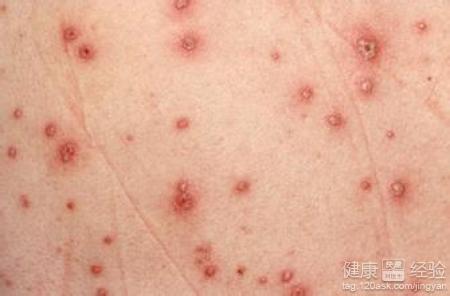 引发带状疱疹的原因 带状疱疹痒怎么原因