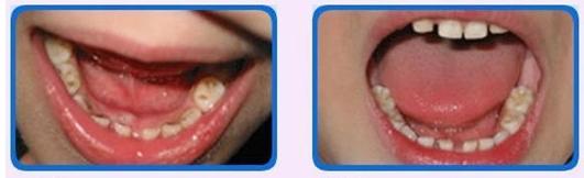 清除黑色牙菌斑的妙招 牙菌斑形成的三个阶段 怎么清除牙菌斑