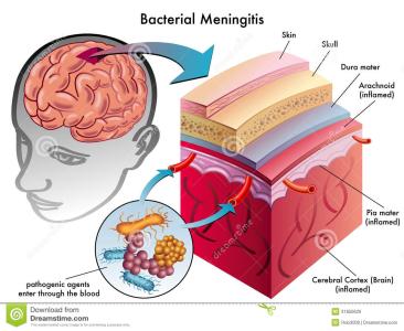 脑膜炎是咋形成的 脑膜炎是怎么形成的