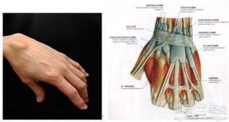 手腕腱鞘囊肿怎么根治 腱鞘囊肿是怎么形成的