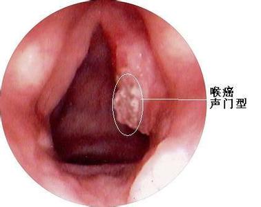 30岁得喉癌是怎么回事 喉癌是怎么回事