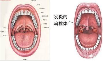 扁桃体发炎 抗生素 扁桃体炎吃什么抗生素 哪些抗生素可以治疗扁桃体发炎