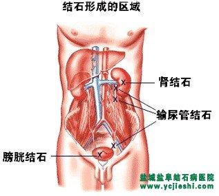 膀胱结石形成的原因 膀胱结石是怎么形成的_膀胱结石的原因