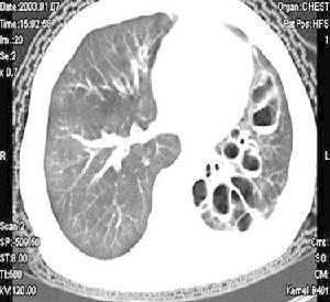 肺囊肿是怎么引起的 肺囊肿是怎么形成的