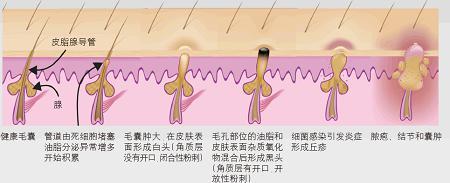 粉刺青春痘怎么治疗 粉刺青春痘怎么形成的