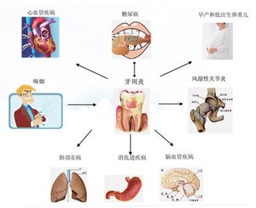 先拔牙还是先洗牙 牙周病怎么形成的