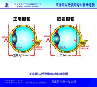 眼睛近视的形成的原因 近视形成的主要原因