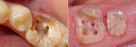 虫牙的危害 虫牙是怎么形成的 虫牙的危害和治疗