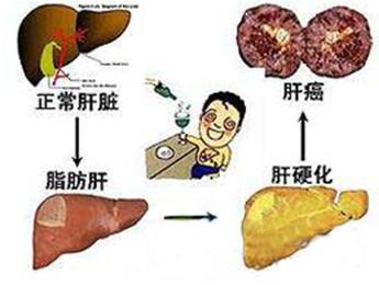 脂肪肝的症状有哪些 脂肪肝是怎么引起的