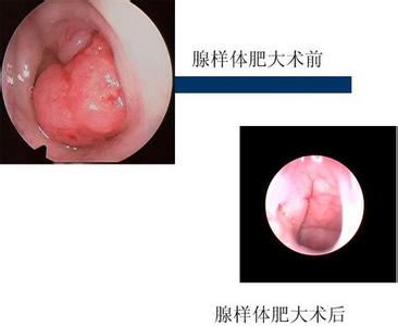 小儿腺样体肥大 小儿为什么会腺样体肥大