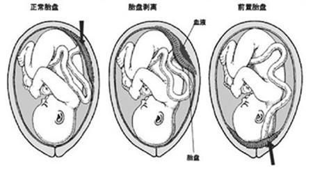 胎盘低置怎么长上去 胎盘低是什么原因造成的