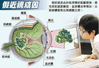 假性近视怎么恢复 “假性近视”考试前夕如何预防