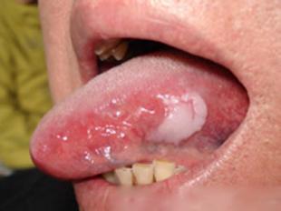 嘴上起泡怎样快速下去 嘴上长泡是哪些病的征兆