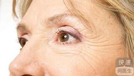 老年人长老年斑 老年斑是怎么形成的 老年人防治老年斑方法