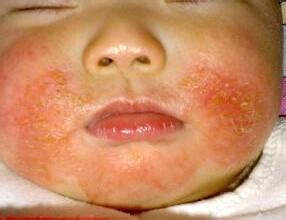 婴儿长湿疹是什么原因 婴儿湿疹的原因是什么？