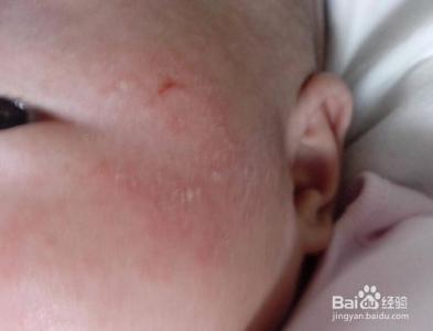 婴儿痱子和湿疹的区别 婴儿湿疹和痱子如何区别看这里