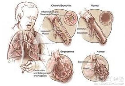 肺气肿不能吃什么食物 肺气肿不能吃什么 肺气肿禁忌食物