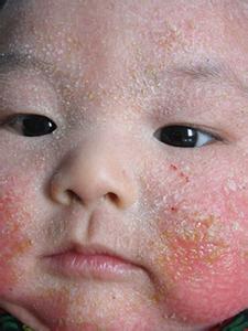 宝宝湿疹饮食注意事项 湿疹宝宝饮食需要注意什么问题