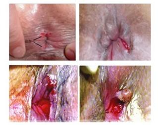 肛裂的症状表现是什么 肛裂是怎样形成的 肛裂的表现是什么
