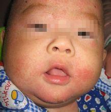 婴儿湿疹吃什么食物 婴儿湿疹吃什么