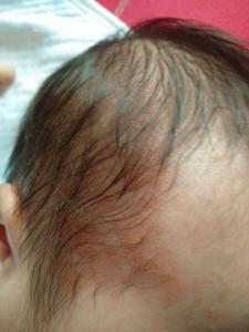 宝宝头上出湿疹怎么办 宝宝头上的湿疹是怎么形成的