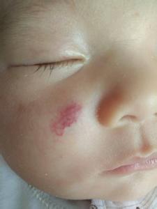 宝宝脸上有红血丝 宝宝脸上红血丝如何形成的